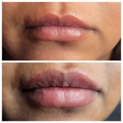 Before and after photo of Dermal filler treatment