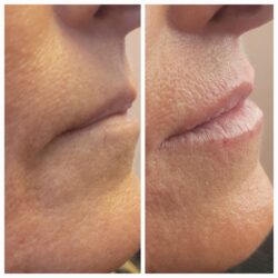 Before and after photo of Dermal filler treatment