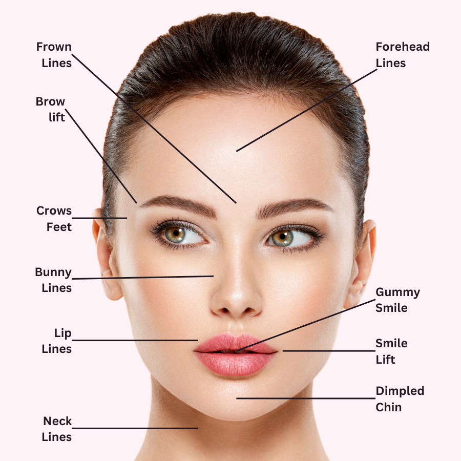 Illustration of common Botox treatment areas, including forehead, crow’s feet, and frown lines.