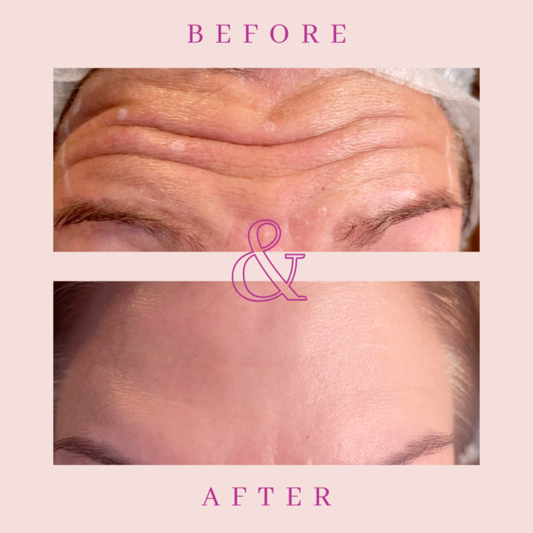 Before and after Botox treatment for for forehead lines wrinkle treatment in Grimsby