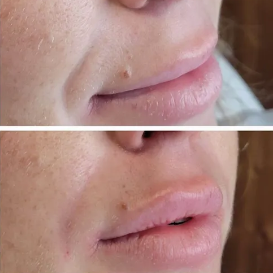 Before and after photo of Dermal filler treatment