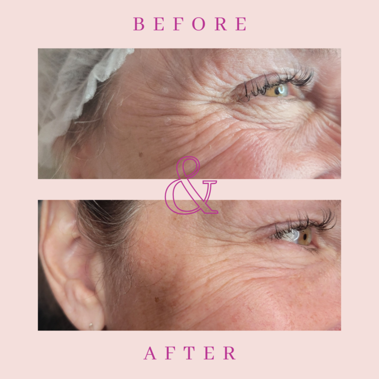 Before and after Dysport treatment for for crows feet wrinkle treatment in Niagara