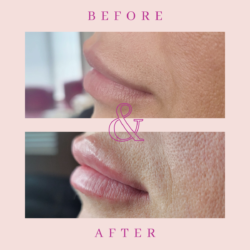 Dermal Fillers results in Hamilton Niagara: Before and after photos.