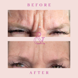 Before and after Botox treatment for for frown lines wrinkle treatment in Hamilton