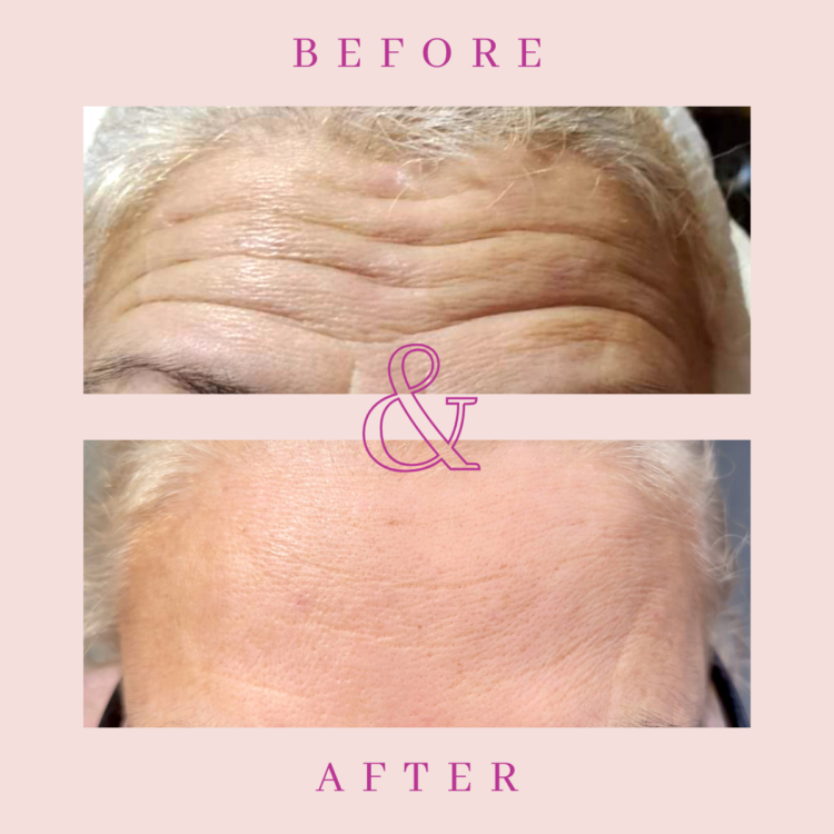 Before and after Botox treatment for for forehead lines wrinkle treatment in Grimsby